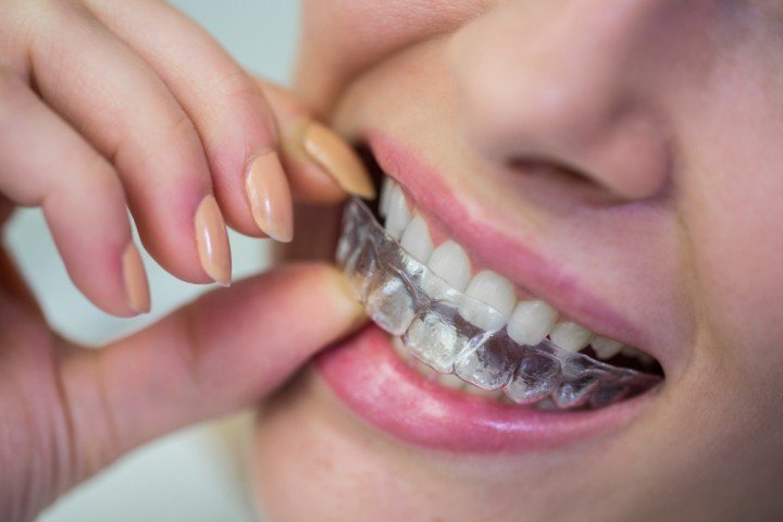 Invisible Aligners in Ras Al Khaimah